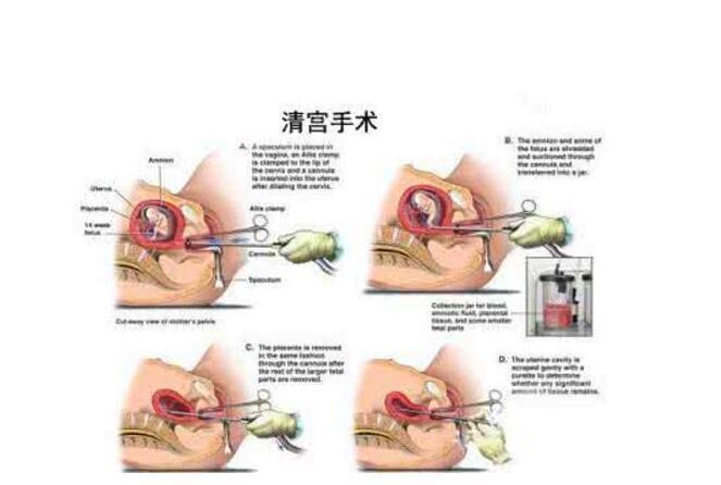 最新人流手術(shù)發(fā)展趨勢及其優(yōu)勢解析