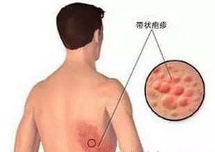 疱疹药最新研究进展及临床应用概述