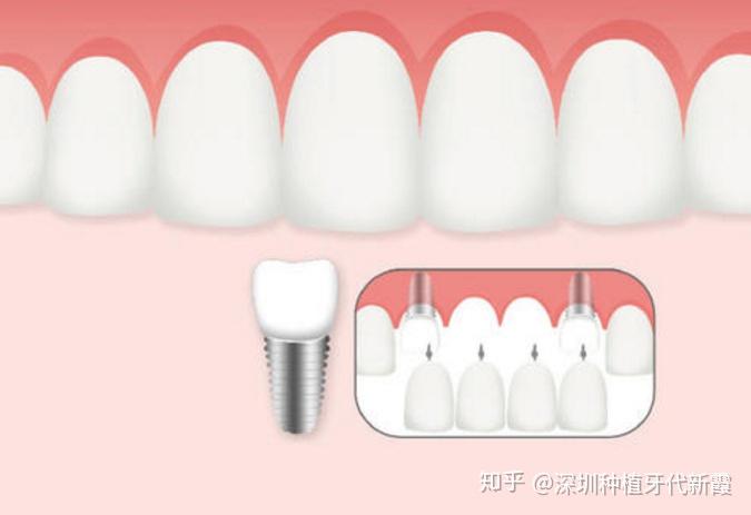 最新牙冠种类，重塑微笑美学与功能之选