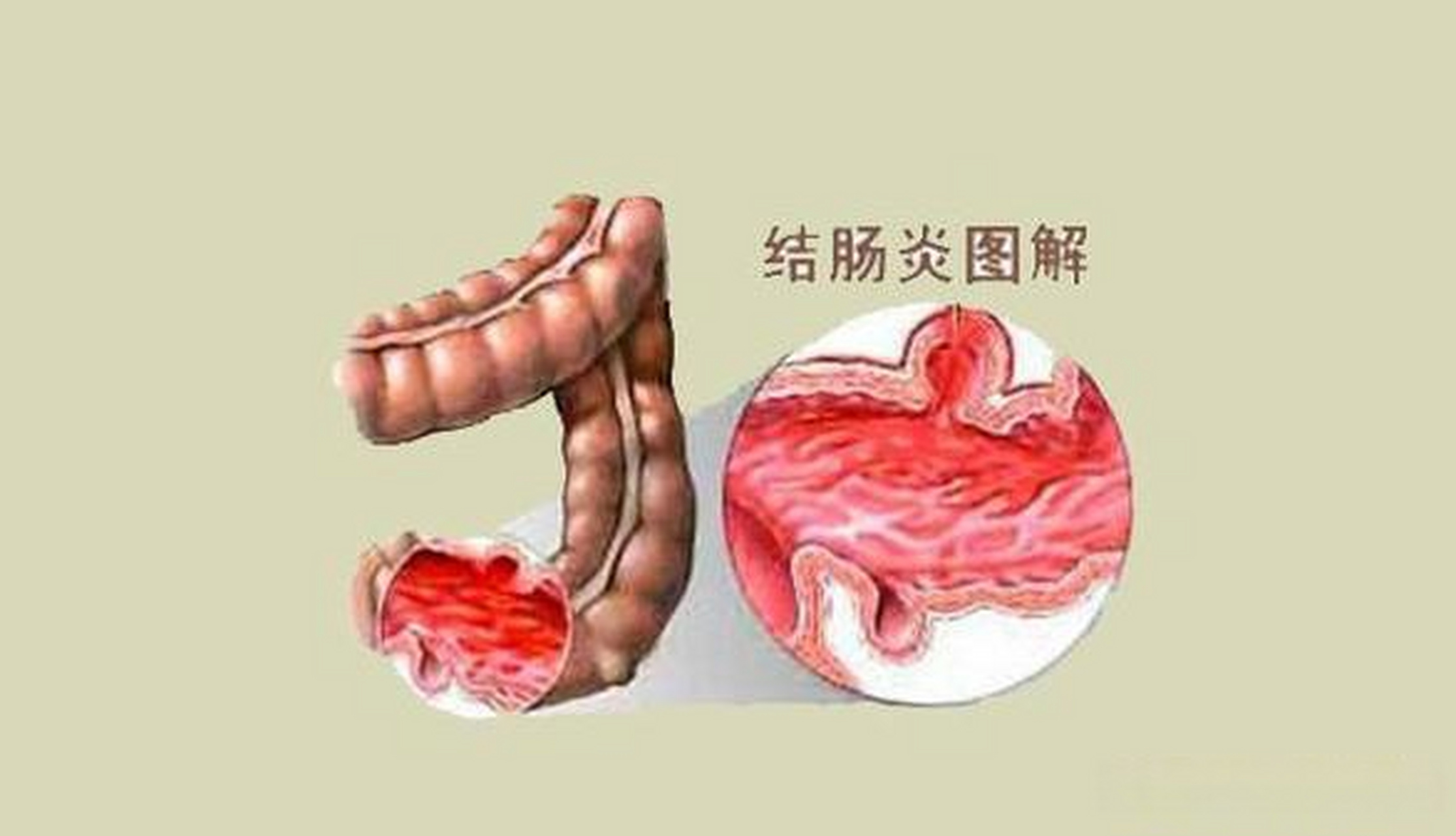 最新肠炎病研究突破与防治策略探讨